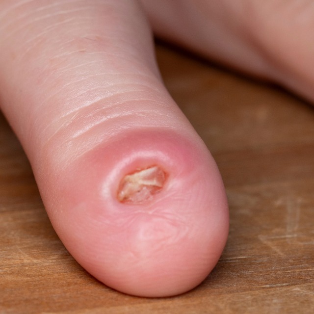Finger wound infection showing delayed treatment amputation risk