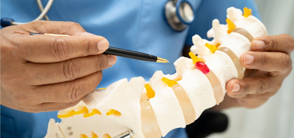 Doctor demonstrating a herniated disk with a spine model