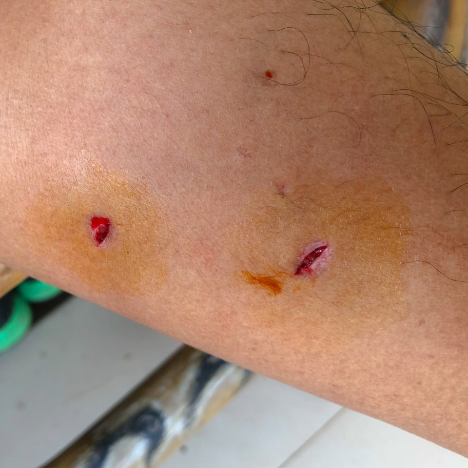 Dog bite injuries that may exceed insurance policy limits