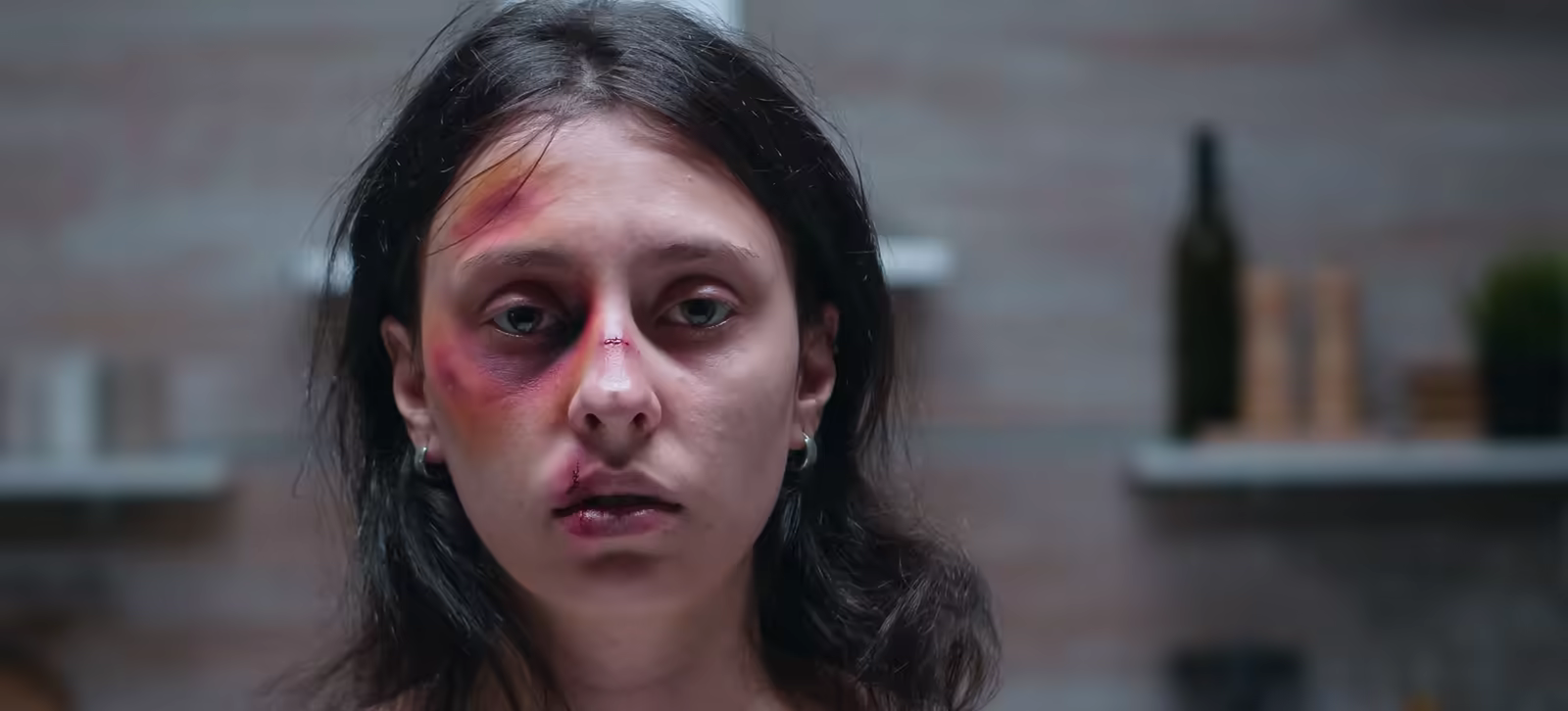 Facial dog bite injury with bruising