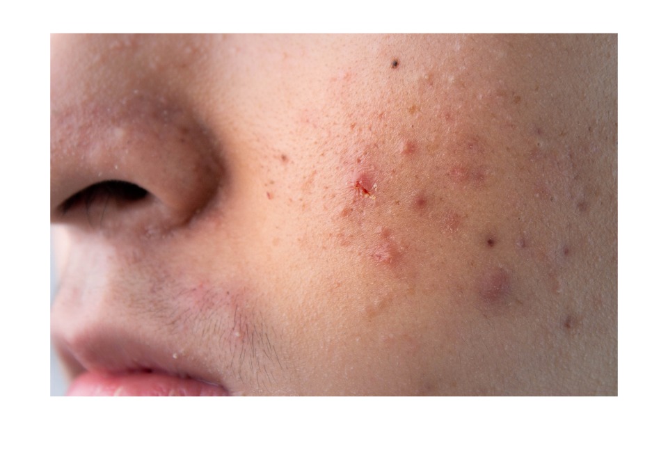 Facial scarring that may require future scar revision care