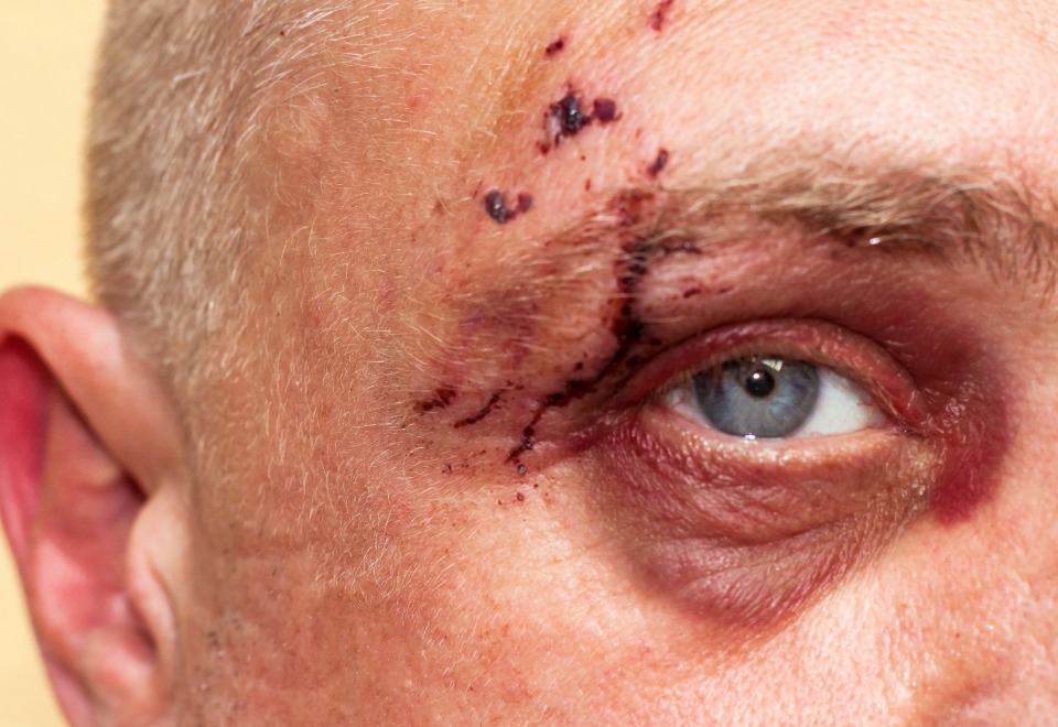Severe facial wound near the eye after an animal bite