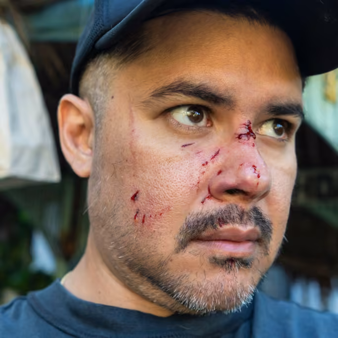 Facial dog bite injuries requiring complex medical care