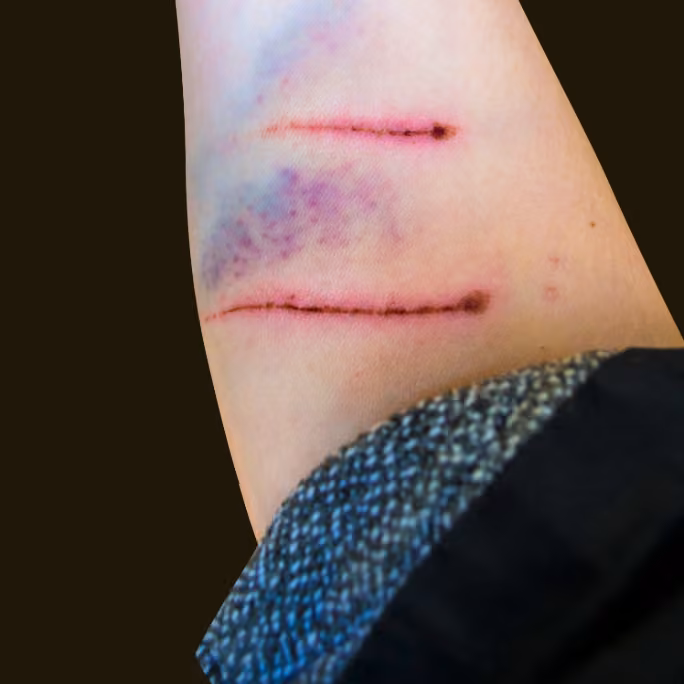 Dog bite wounds and bruising used to document infection progression