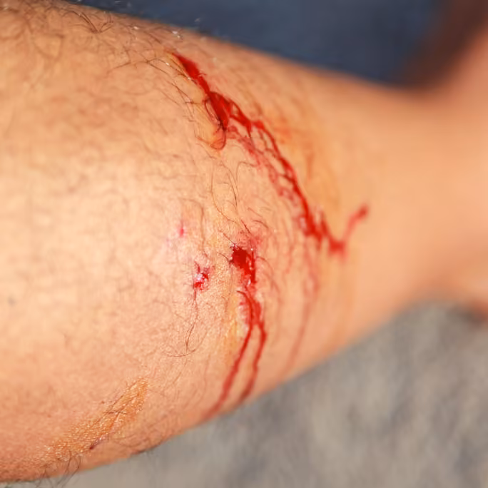 Bleeding dog bite puncture wounds that can trap bacteria