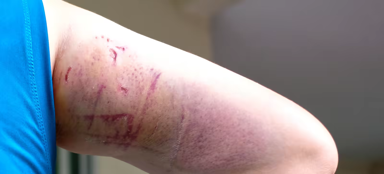 Infected dog bite wound with bruising