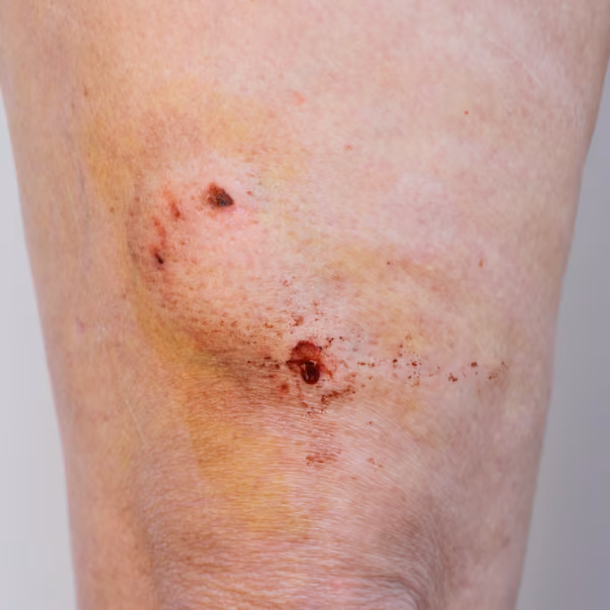 Dog bite wound showing signs of infection and bruising