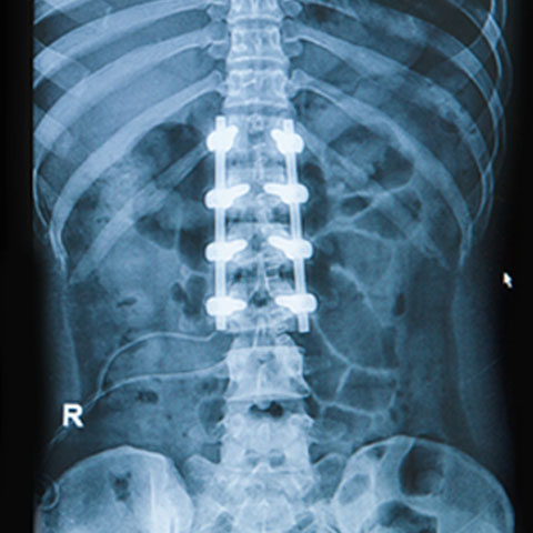 Dog bite neck and spinal injury consultation