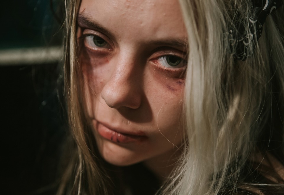 Injuries after an alcohol-related incident